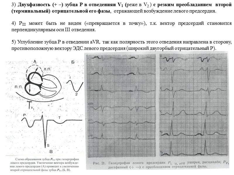 3) Двухфазность (+ –) зубца Р в отведенияи V1 (реже в V2 ) с 3) Двухфазность (+ –) зубца Р в отведенияи V1 (реже в V2 ) с